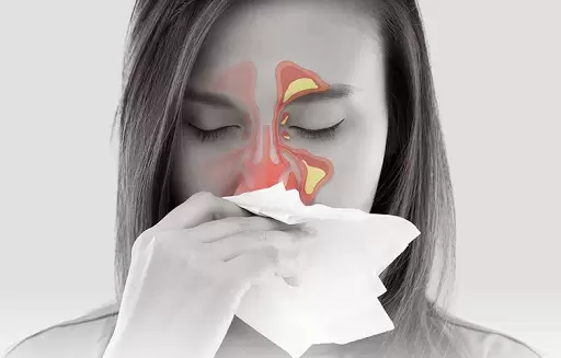 Allergic Rhinitis: Symptoms, Causes, and Treatment Options